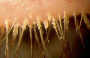 Flakes or crusts around the root of the eyelashes